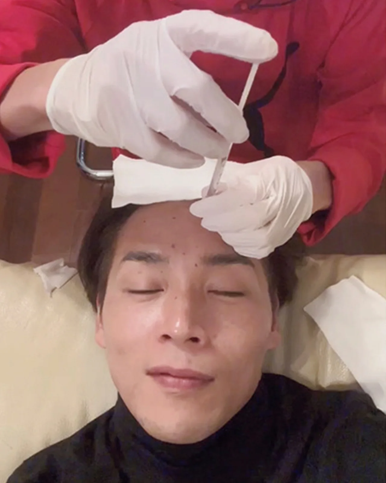 ボトックス注射