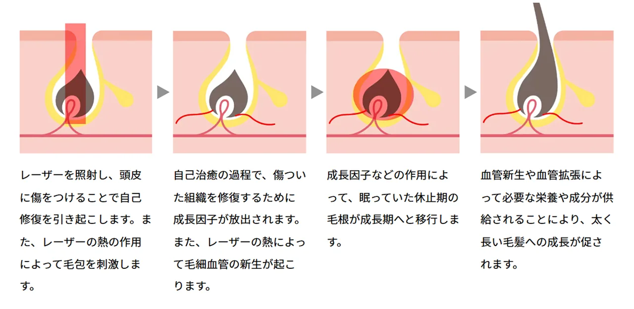 【大人の薄毛ケア】AGA新治療機器が登場の画像_3