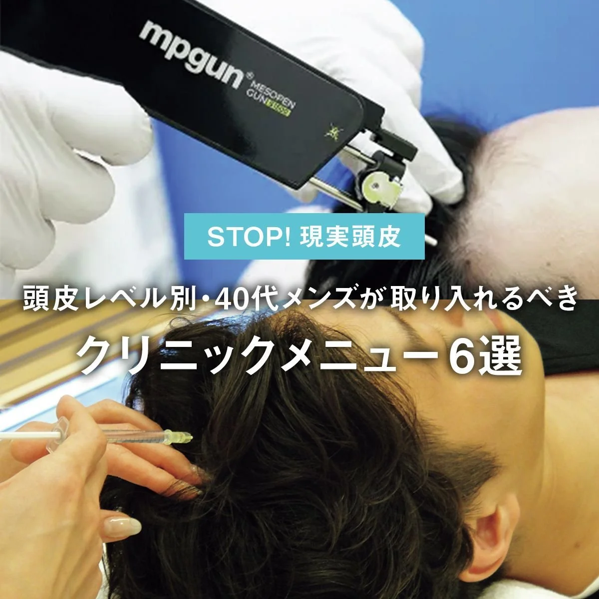 【STOP! 現実頭皮】頭皮レベル別・40代メンズが取り入れるべきクリニックメニュー6選