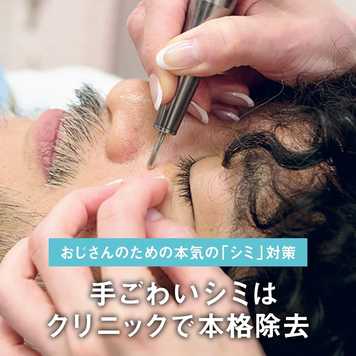 【おじさんのための本気の「シミ」対策】手ごわいシミはクリニックで本格除去